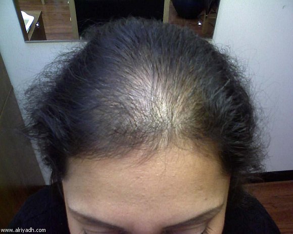 خلل الغدد الدرقية يؤثر على الشعر 