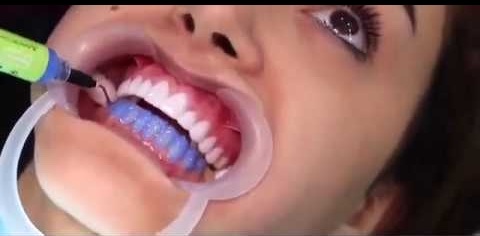 تبيض الاسنان بالليزر