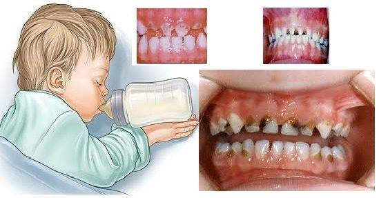تسوس أسنان الأطفال البنية