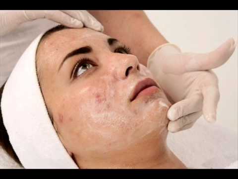 علاج حب الشباب 2 علاج حب الشباب 2