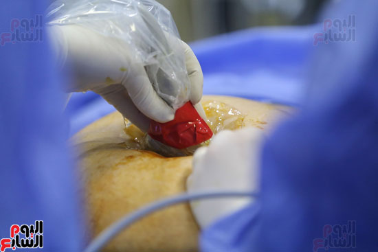عملية جراحية لنقل دم لجنين داخل الرحم (4)