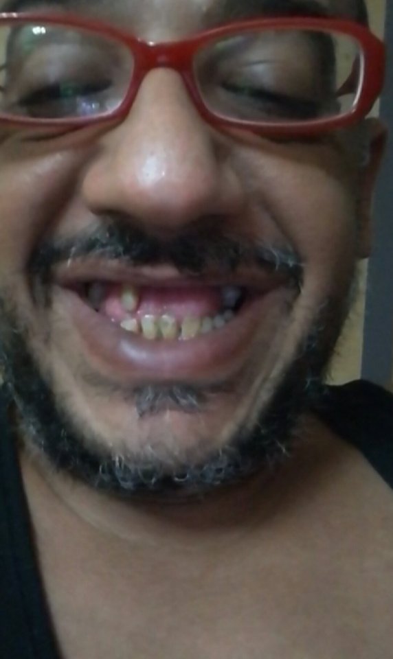 المريض بعد افساد اسنانه