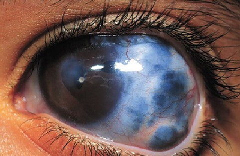 المياة-الزرقاء-على-العين