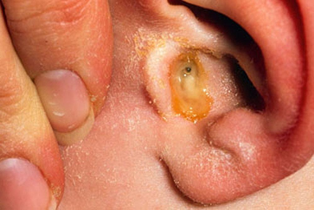 اعراض التهاب الأذن الوسطى