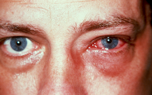 العين المفاجئ احمرار تشخيص علة