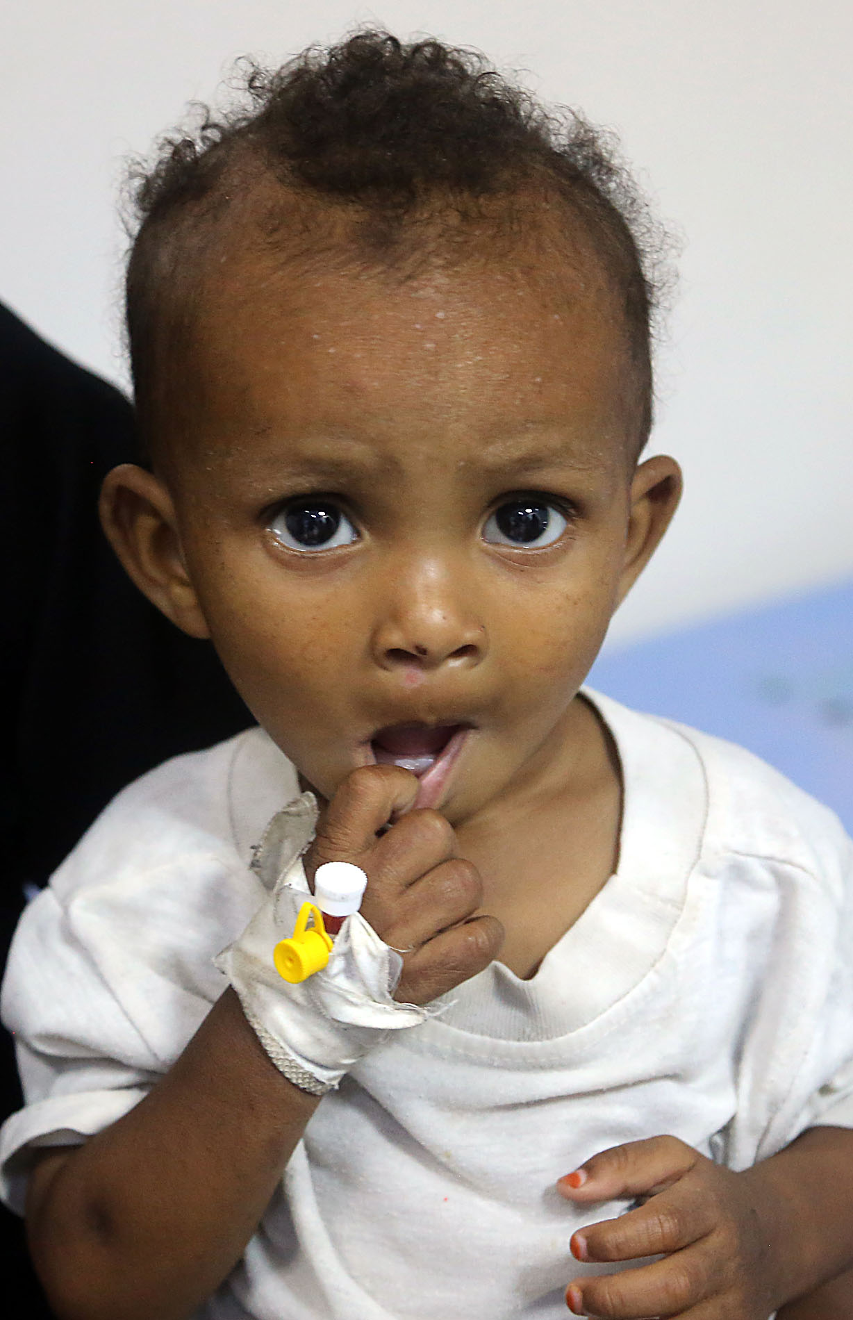 طفل مصاب بسوء تغذية فى اليمن