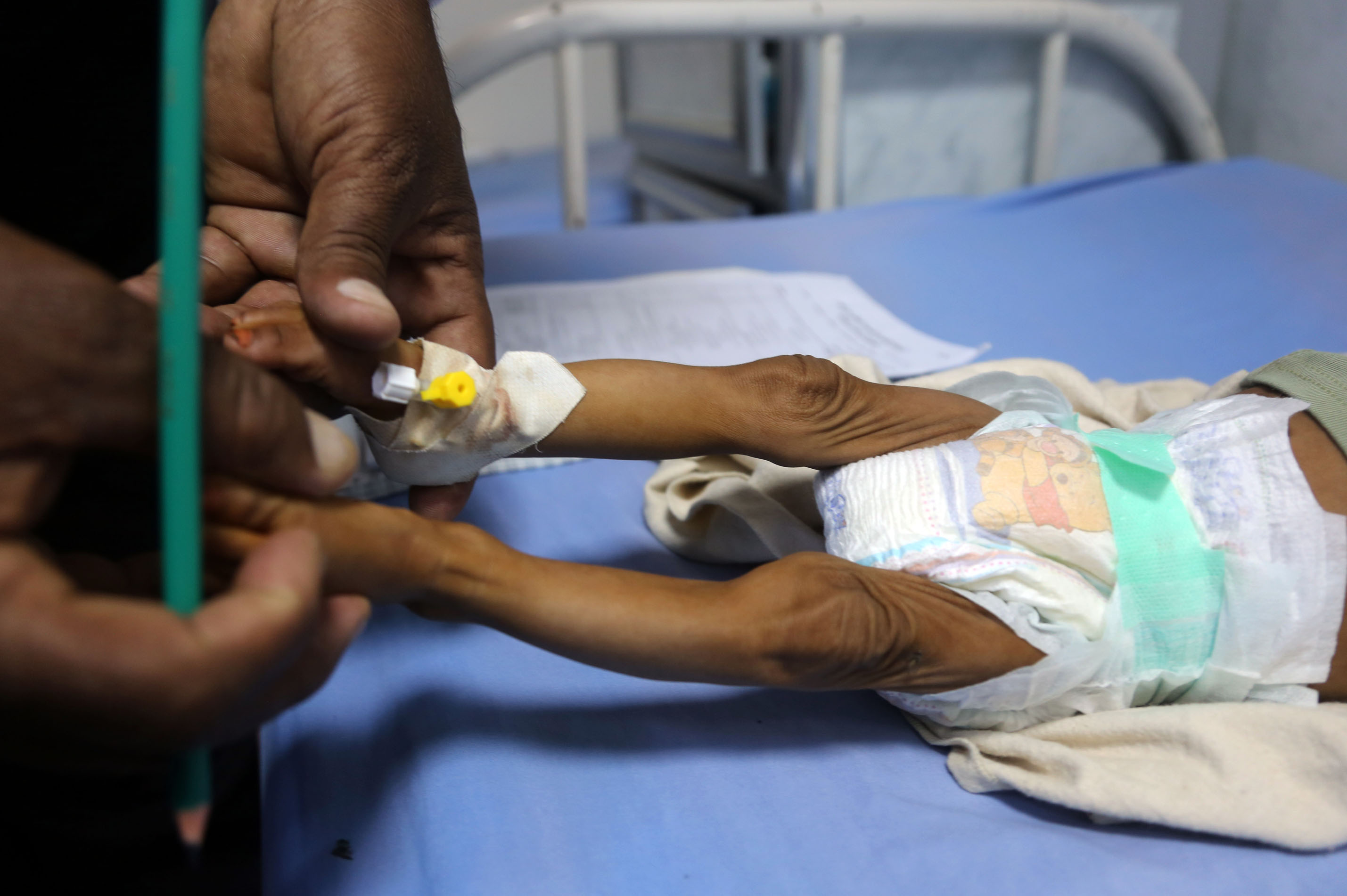 سوء التغذية يهددان حياة أطفال اليمن