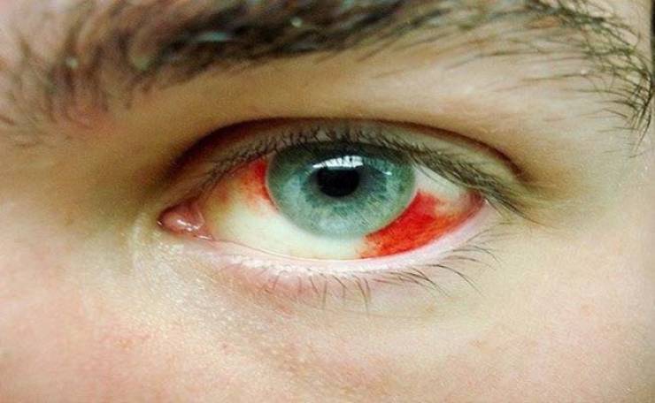 علاج نزيف العين