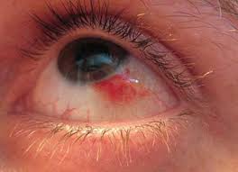 علاج نزيف العين 3