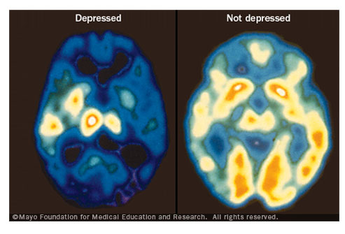 تأثير الاكتئاب على المخ
