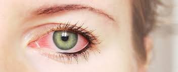التهاب ملتحمة العين