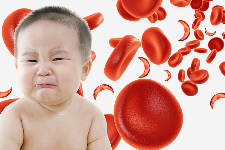 الانيميا المنجلية من امراض الدم الوراثية