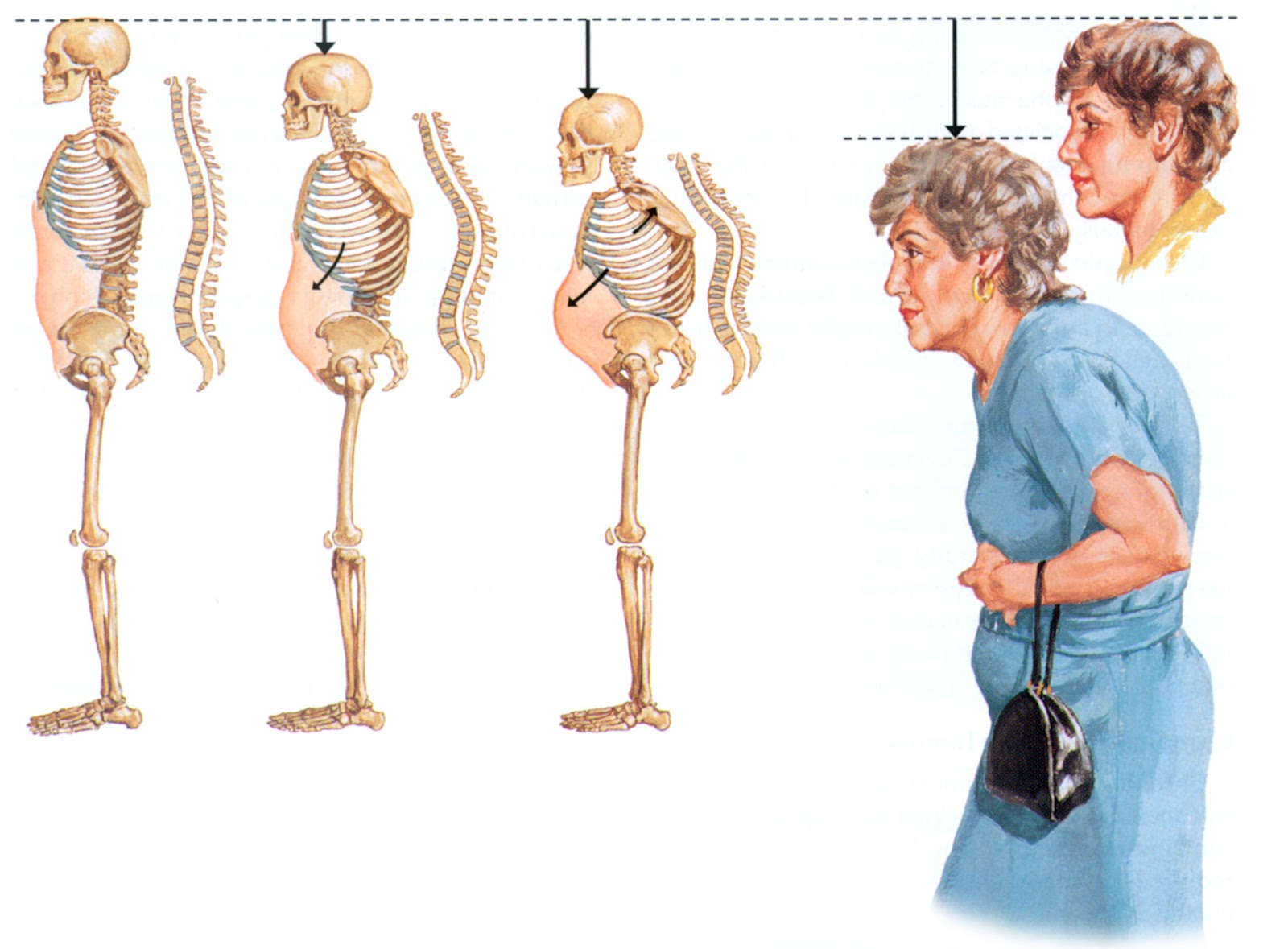 تقوس الظهر من اعراض هشاشة العظام
