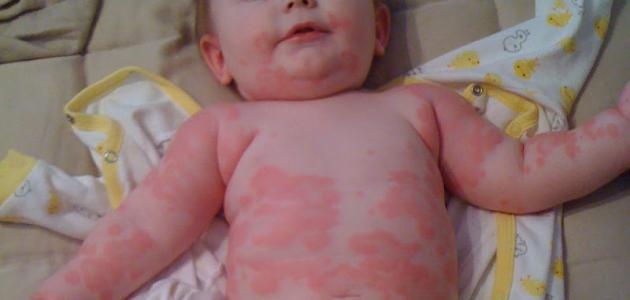 اعراض حساسية الحليب عند الرضع اليوم السابع