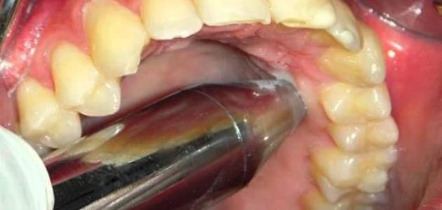 علاج خراج الأسنان بين الجراحة والمضادات الحيوية - اليوم السابع