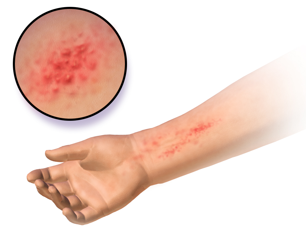 Allergic symptoms of blood
