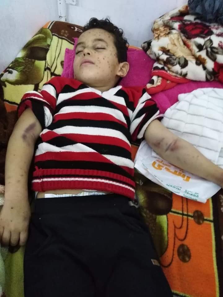 الطفل محمد إبراهيم محمد إبراهيم 5 سنوات مُصاب بسرطان الدم (6)