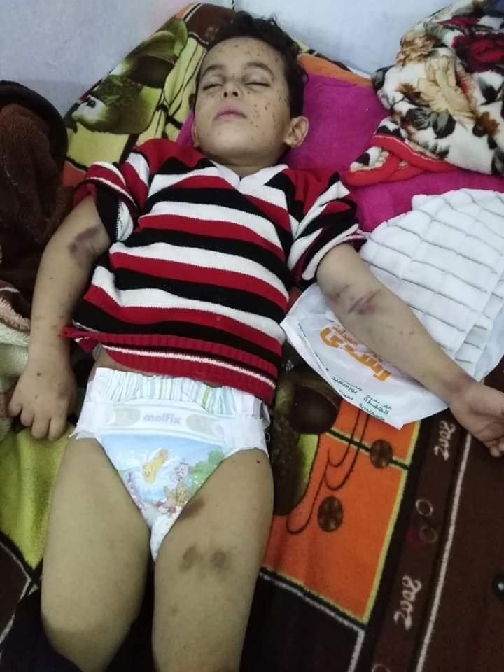 الطفل محمد إبراهيم محمد إبراهيم 5 سنوات مُصاب بسرطان الدم (5)