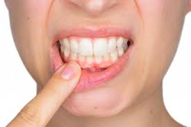 التهاب دواعم الاسنان منها للثة والانسجة