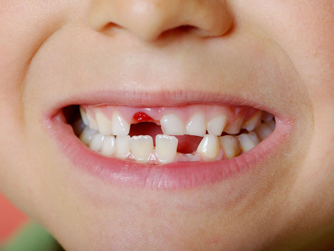 مراحل فقدان الاسنان ععند الافطال