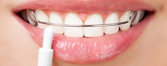 تقويم الاسنان يؤثر على اللثة