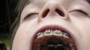 التقويم قد يؤثر على الاسنان