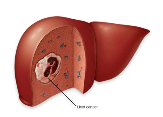 سرطان الكبد