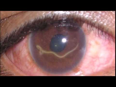 اسباب الاصابة بطفيليات العين