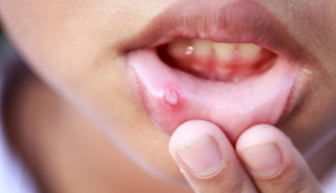 اعراض حمو الفم