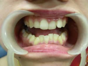 مشاكل الاسنان المتوية