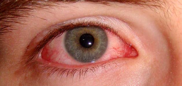 اعراض نزيف العين