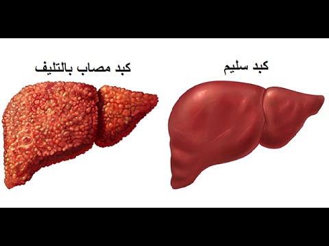 اسباب تليف الكبد من ضمنها الدهون والالتهابات اليوم السابع
