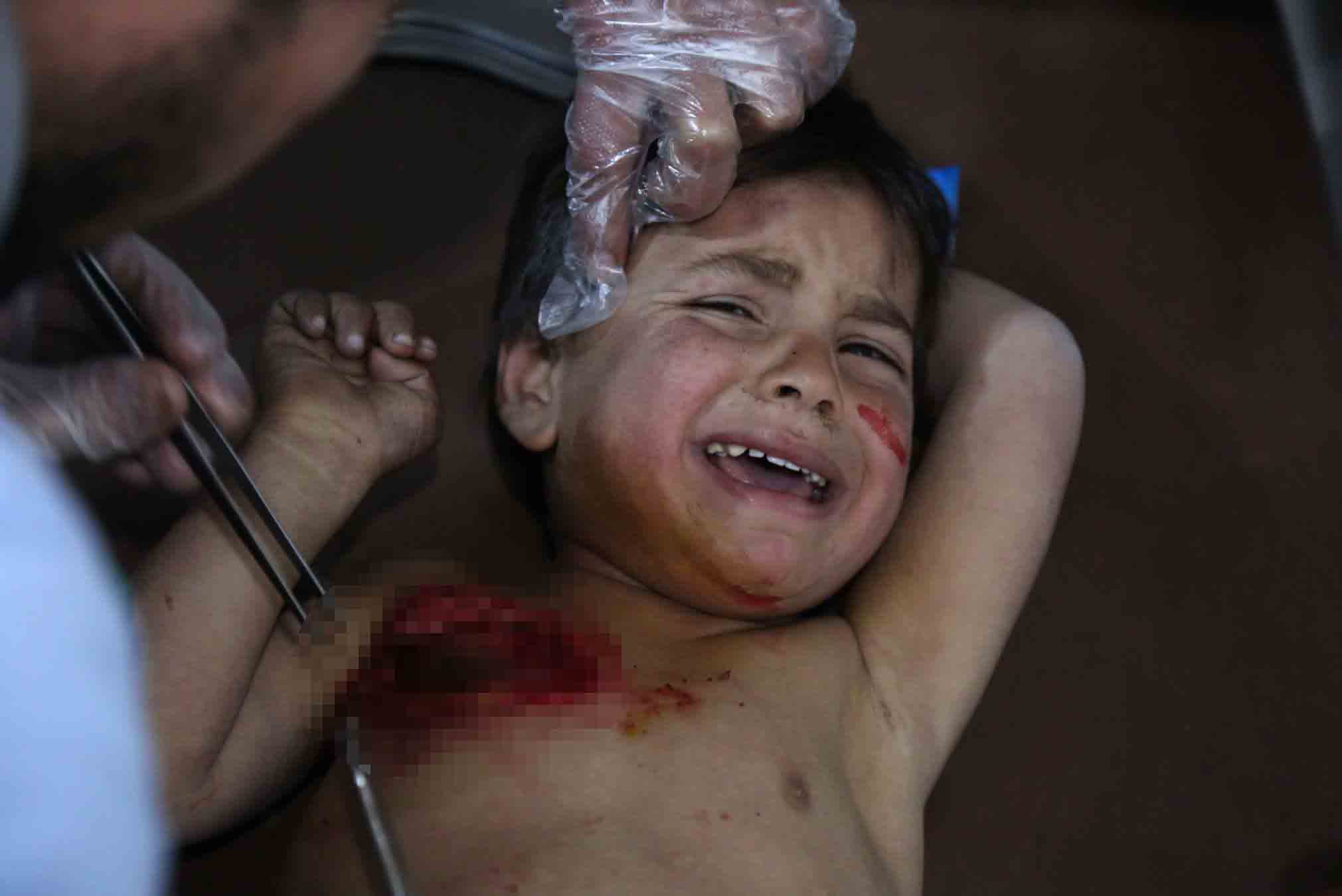 طفل مصاب فى الغوطة