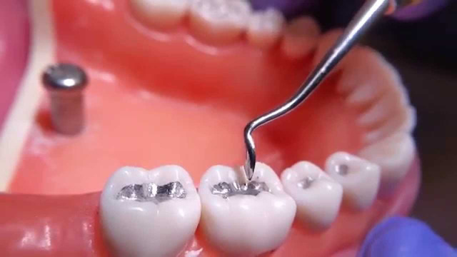 كيفية التعامل مع آلام الاسنان الامامية بعد الحشو