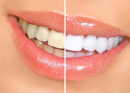 وصفات طبيعية لتبييض الأسنان (3)