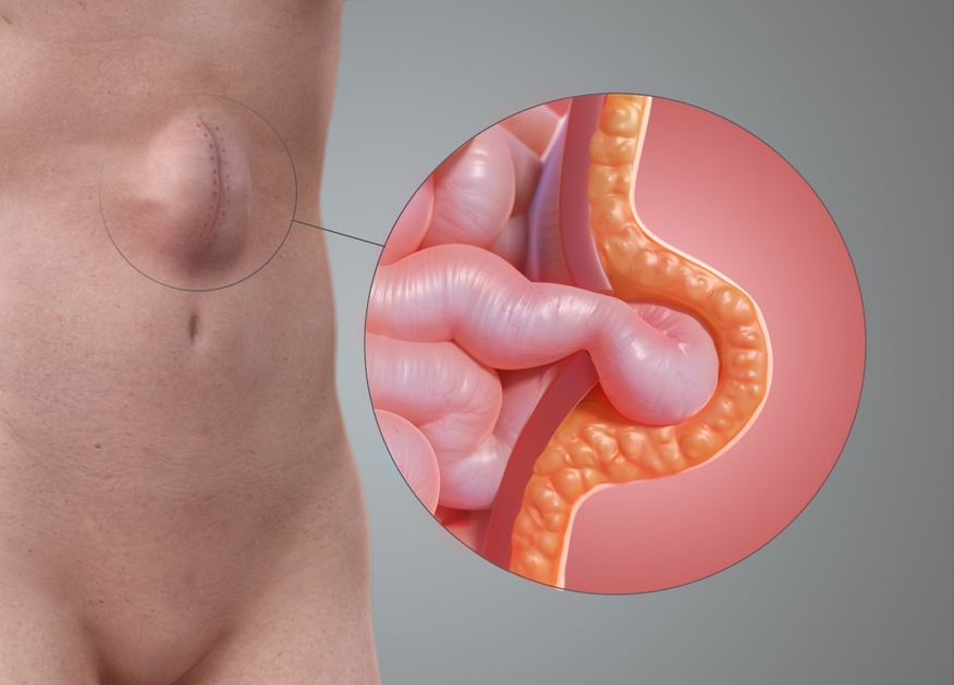 الفتق الاربى بروز فى البطن