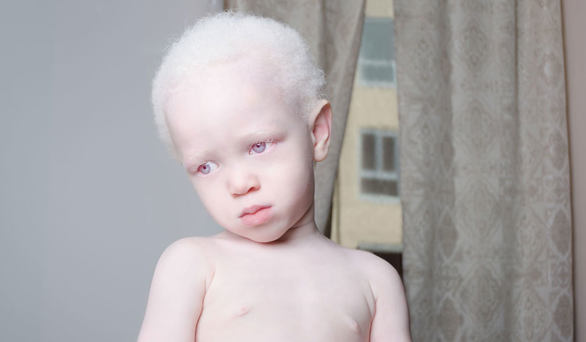 طفل مصاب بالبرص