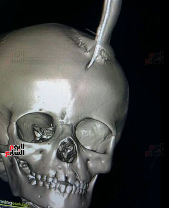 الأشعة توضح وجود المنجل بالجمجمة