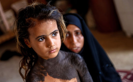 الطفلة العراقية المصابة 