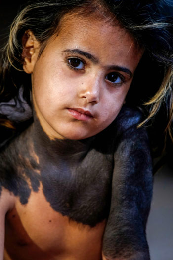 طفلة عراقية مصابة بمرض جلدى نادر 