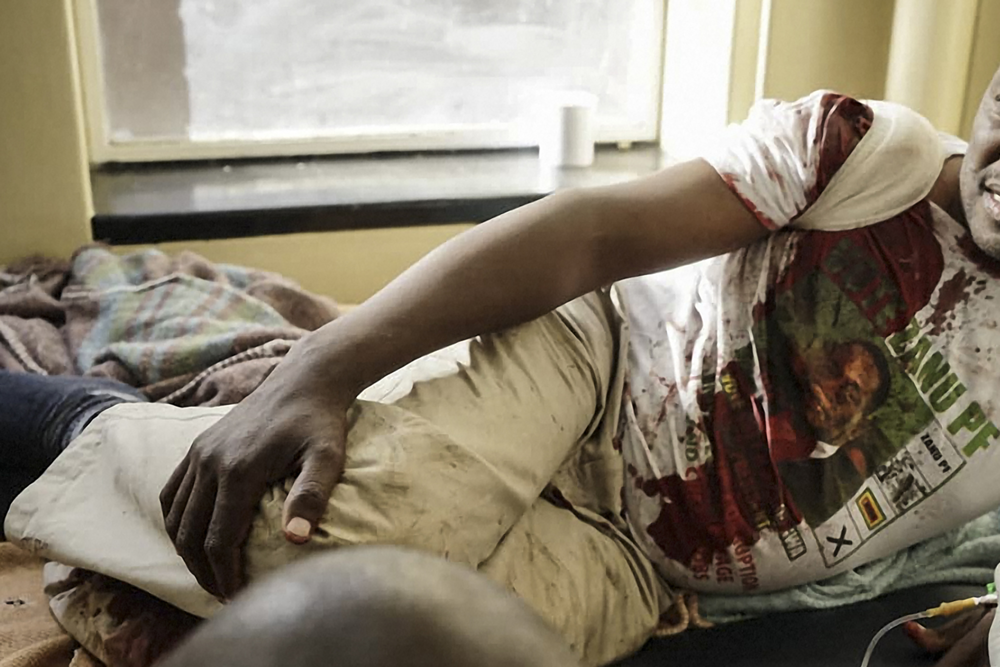 أحد المصابين فى حادث التفجير بزيمبابوى