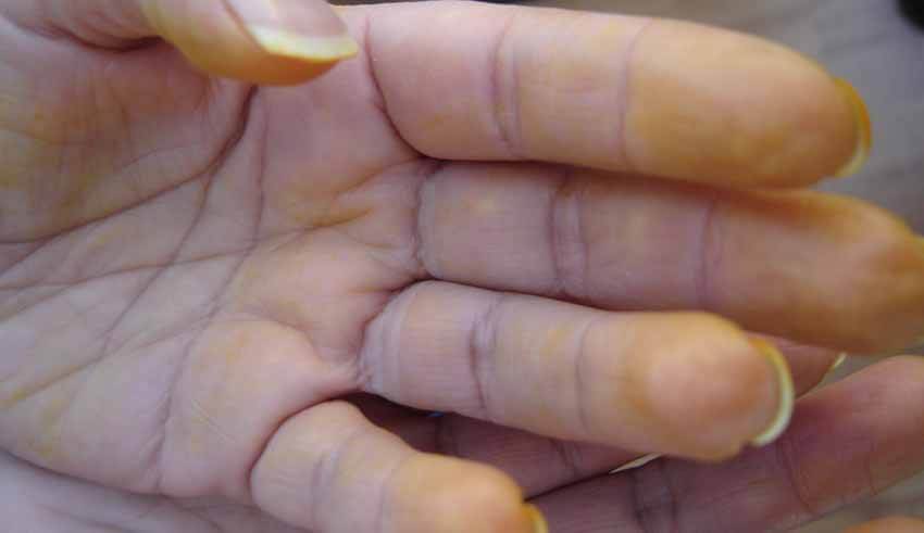 اصفرار البشرة اصفرار البشرة