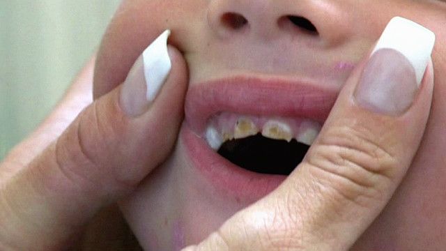 علاج تسوس الاسنان المبكر