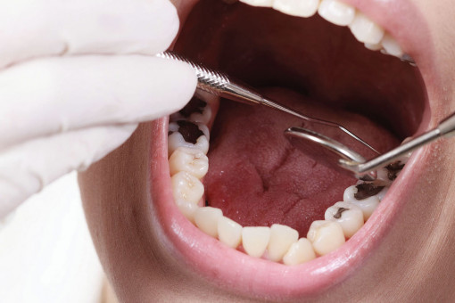 خطوات علاج تجويف الاسنان