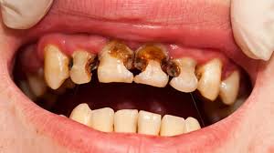 علاج تسوس الاسنان المتقدم