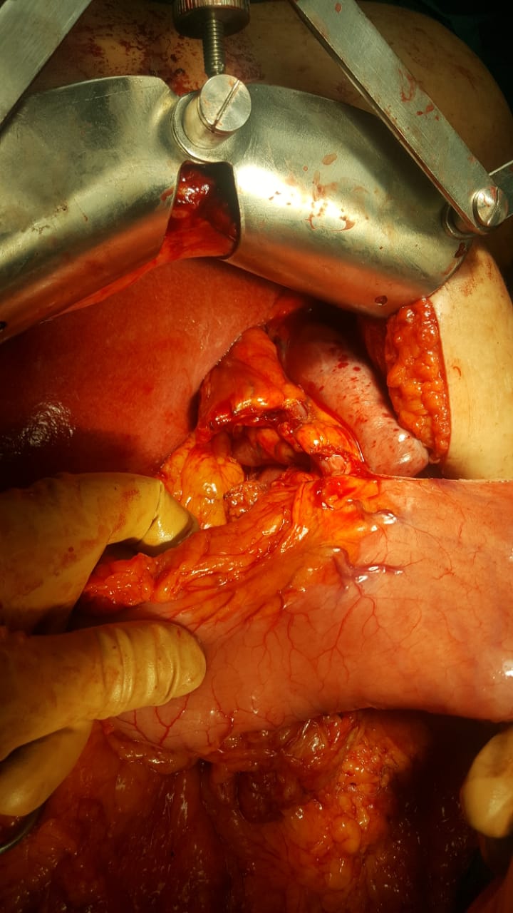اجراء اول عملية استئصال ورم بالمرئ وتكوين أنبوبة من المعدة وتمريرها داخل الصدر لسيدة بمستشفى اورام الاسماعيلية (7)