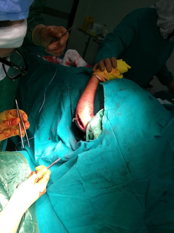  إجراء جراحة من جراحات إصلاح تشوهات عظام اﻷطفال (2)