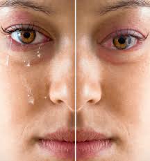 اعراض جفاف العين  2
