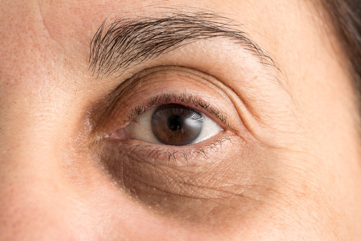 نصائح لعلاج السواد تحت العين 2