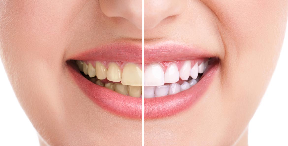 استخدام الفلورايد المفرط من اسباب اصفرار الاسنان